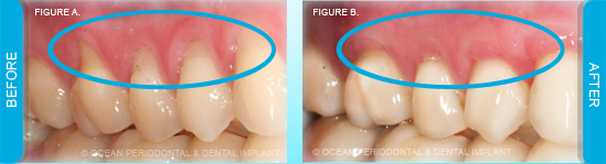 gum-recession-root-exposure-ocean-periodontal-dental-implant