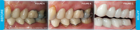 Restorative Crown Lengthening - Ocean Periodontal & Dental Implant ...